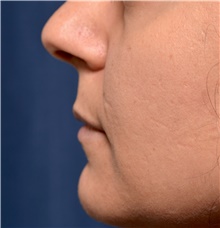 Lip Augmentation/Enhancement Before Photo by Michael Frederick, MD; Fort Lauderdale, FL - Case 39991