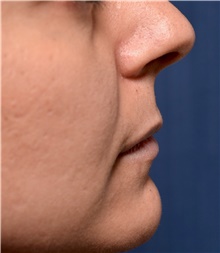 Lip Augmentation/Enhancement Before Photo by Michael Frederick, MD; Fort Lauderdale, FL - Case 39991