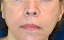 Lip Augmentation/Enhancement After Photo by Michael Frederick, MD; Fort Lauderdale, FL - Case 39993