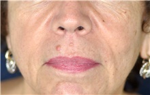 Lip Augmentation/Enhancement Before Photo by Michael Frederick, MD; Fort Lauderdale, FL - Case 39993