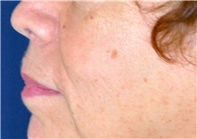 Lip Augmentation/Enhancement Before Photo by Michael Frederick, MD; Fort Lauderdale, FL - Case 39993