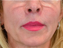 Lip Augmentation/Enhancement After Photo by Michael Frederick, MD; Fort Lauderdale, FL - Case 39996