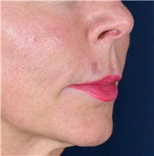 Lip Augmentation/Enhancement Before Photo by Michael Frederick, MD; Fort Lauderdale, FL - Case 39996
