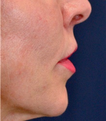 Lip Augmentation/Enhancement After Photo by Michael Frederick, MD; Fort Lauderdale, FL - Case 39996