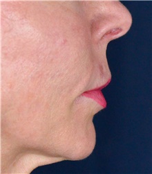 Lip Augmentation/Enhancement Before Photo by Michael Frederick, MD; Fort Lauderdale, FL - Case 39996