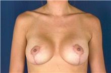 Breast Lift After Photo by Michael Frederick, MD; Fort Lauderdale, FL - Case 40005