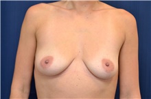 Breast Lift Before Photo by Michael Frederick, MD; Fort Lauderdale, FL - Case 40005