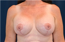 Breast Lift After Photo by Michael Frederick, MD; Fort Lauderdale, FL - Case 40009