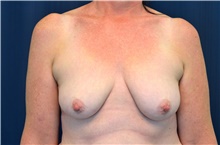 Breast Lift Before Photo by Michael Frederick, MD; Fort Lauderdale, FL - Case 40009