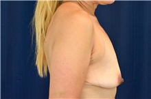 Breast Lift Before Photo by Michael Frederick, MD; Fort Lauderdale, FL - Case 40012