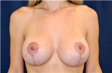 Breast Lift After Photo by Michael Frederick, MD; Fort Lauderdale, FL - Case 40013