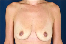 Breast Lift Before Photo by Michael Frederick, MD; Fort Lauderdale, FL - Case 40013