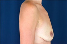 Breast Lift Before Photo by Michael Frederick, MD; Fort Lauderdale, FL - Case 40013
