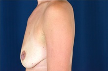 Breast Lift Before Photo by Michael Frederick, MD; Fort Lauderdale, FL - Case 40013