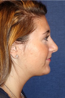 Rhinoplasty After Photo by Michael Frederick, MD; Fort Lauderdale, FL - Case 40014