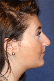 Rhinoplasty Before Photo by Michael Frederick, MD; Fort Lauderdale, FL - Case 40014