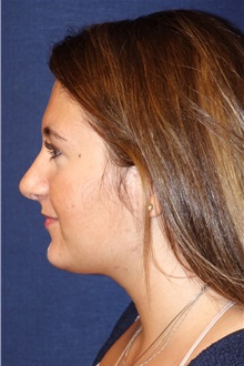 Rhinoplasty After Photo by Michael Frederick, MD; Fort Lauderdale, FL - Case 40014