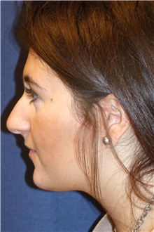 Rhinoplasty Before Photo by Michael Frederick, MD; Fort Lauderdale, FL - Case 40014