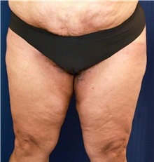 Thigh Lift After Photo by Michael Frederick, MD; Fort Lauderdale, FL - Case 40016