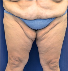 Thigh Lift Before Photo by Michael Frederick, MD; Fort Lauderdale, FL - Case 40016