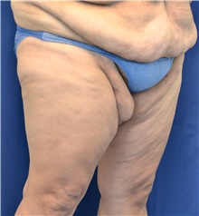 Thigh Lift Before Photo by Michael Frederick, MD; Fort Lauderdale, FL - Case 40016