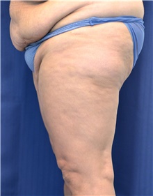 Thigh Lift Before Photo by Michael Frederick, MD; Fort Lauderdale, FL - Case 40016