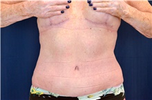 Tummy Tuck After Photo by Michael Frederick, MD; Fort Lauderdale, FL - Case 40017