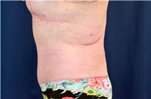 Tummy Tuck After Photo by Michael Frederick, MD; Fort Lauderdale, FL - Case 40017