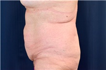 Tummy Tuck Before Photo by Michael Frederick, MD; Fort Lauderdale, FL - Case 40017