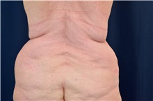 Tummy Tuck Before Photo by Michael Frederick, MD; Fort Lauderdale, FL - Case 40017