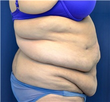 Tummy Tuck Before Photo by Michael Frederick, MD; Fort Lauderdale, FL - Case 40019
