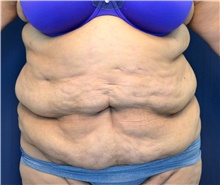 Tummy Tuck Before Photo by Michael Frederick, MD; Fort Lauderdale, FL - Case 40019
