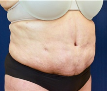 Tummy Tuck After Photo by Michael Frederick, MD; Fort Lauderdale, FL - Case 40019