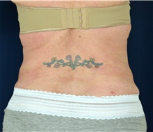 Tummy Tuck After Photo by Michael Frederick, MD; Fort Lauderdale, FL - Case 40020