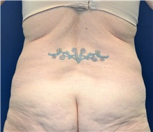 Tummy Tuck Before Photo by Michael Frederick, MD; Fort Lauderdale, FL - Case 40020