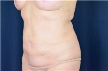 Tummy Tuck Before Photo by Michael Frederick, MD; Fort Lauderdale, FL - Case 40022
