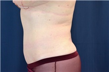 Tummy Tuck After Photo by Michael Frederick, MD; Fort Lauderdale, FL - Case 40022