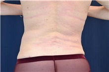 Tummy Tuck After Photo by Michael Frederick, MD; Fort Lauderdale, FL - Case 40022