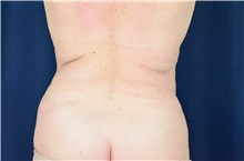 Tummy Tuck Before Photo by Michael Frederick, MD; Fort Lauderdale, FL - Case 40022