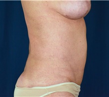 Tummy Tuck After Photo by Michael Frederick, MD; Fort Lauderdale, FL - Case 40023