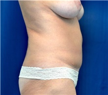 Tummy Tuck Before Photo by Michael Frederick, MD; Fort Lauderdale, FL - Case 40023