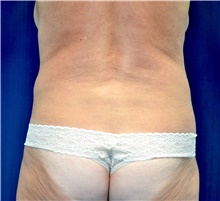 Tummy Tuck Before Photo by Michael Frederick, MD; Fort Lauderdale, FL - Case 40023