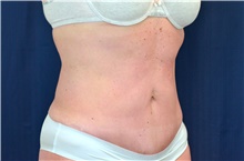 Tummy Tuck After Photo by Michael Frederick, MD; Fort Lauderdale, FL - Case 40031