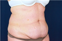 Tummy Tuck Before Photo by Michael Frederick, MD; Fort Lauderdale, FL - Case 40031