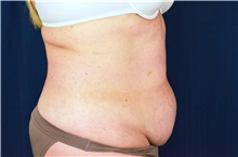 Tummy Tuck Before Photo by Michael Frederick, MD; Fort Lauderdale, FL - Case 40031