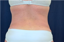 Tummy Tuck After Photo by Michael Frederick, MD; Fort Lauderdale, FL - Case 40031