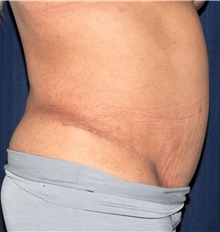 Tummy Tuck After Photo by Michael Frederick, MD; Fort Lauderdale, FL - Case 40032