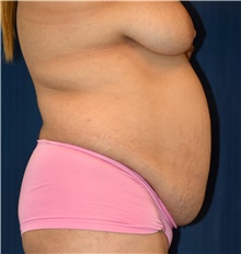 Tummy Tuck Before Photo by Michael Frederick, MD; Fort Lauderdale, FL - Case 40032