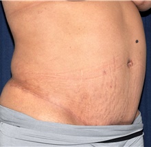 Tummy Tuck After Photo by Michael Frederick, MD; Fort Lauderdale, FL - Case 40032