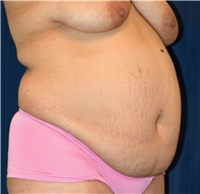Tummy Tuck Before Photo by Michael Frederick, MD; Fort Lauderdale, FL - Case 40032